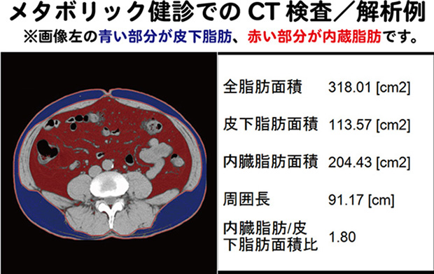 メタボリック検診でのCT検査解析例