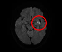 頭部MRI画像（DWI）