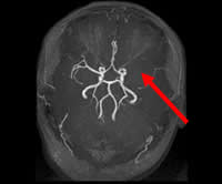 脳血管MRA