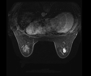 乳腺MRI