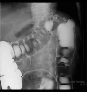 注腸検査（大腸造影）