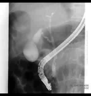 ERCP