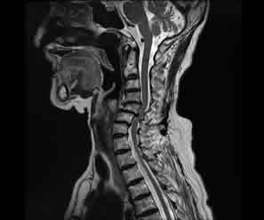 頸部脊柱管狭窄症