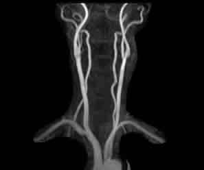 大動脈～頸部動脈MRA