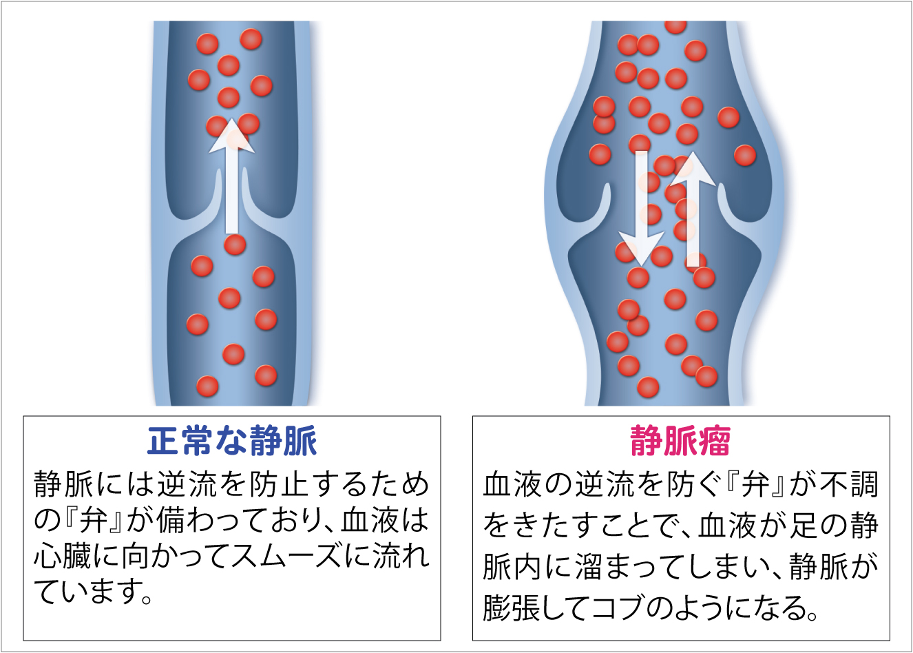 下肢静脈瘤の治療 外科 鎌ケ谷総合病院