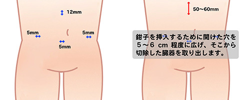 上向結腸がんの腹腔鏡手術