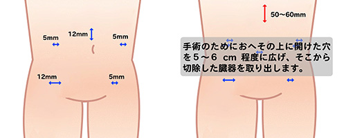 S状結腸がんの腹腔鏡手術