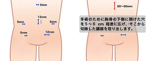 早期胃がんの腹腔鏡手術