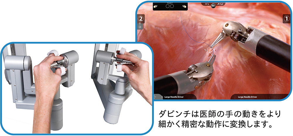 ダビンチは医師の手の動きをより細かく精密な動作に変換します。