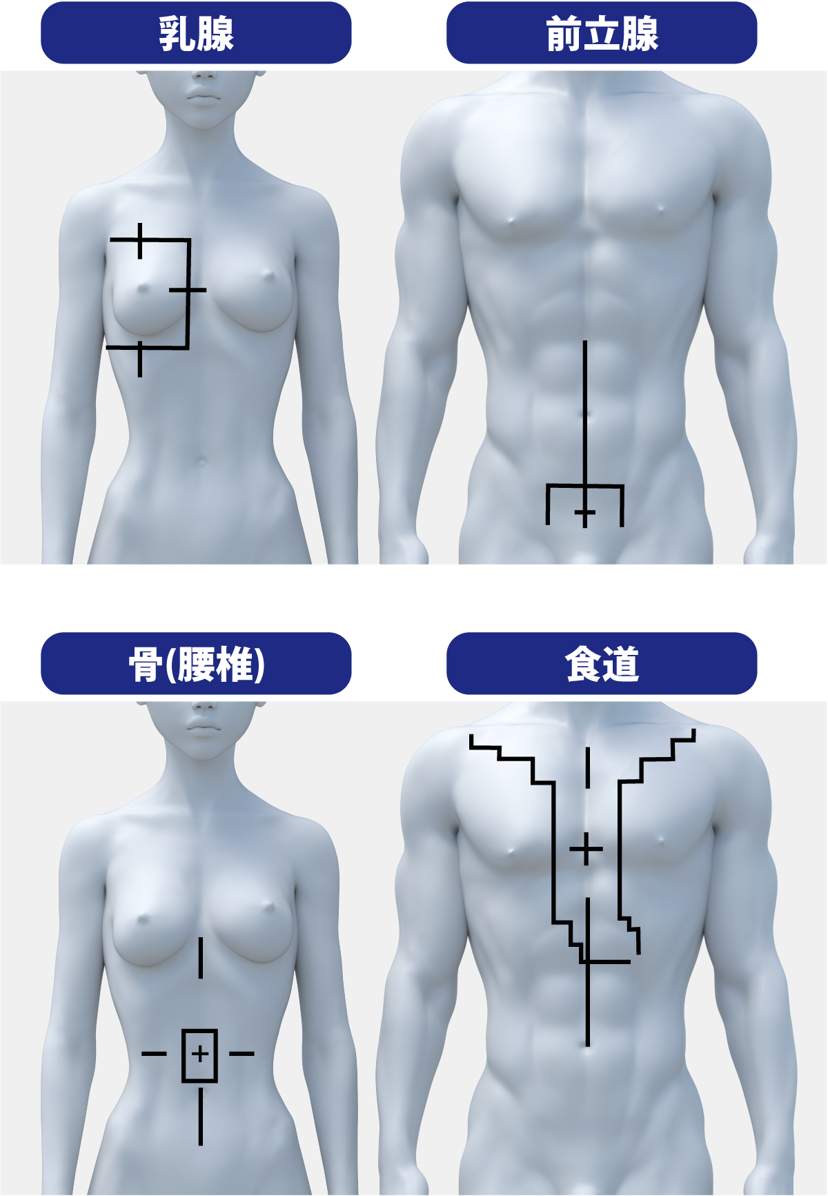 放射線治療乳腺、前立腺、骨、食道マーキング